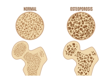 Xerrada - Què cal saber de l'osteoporosi